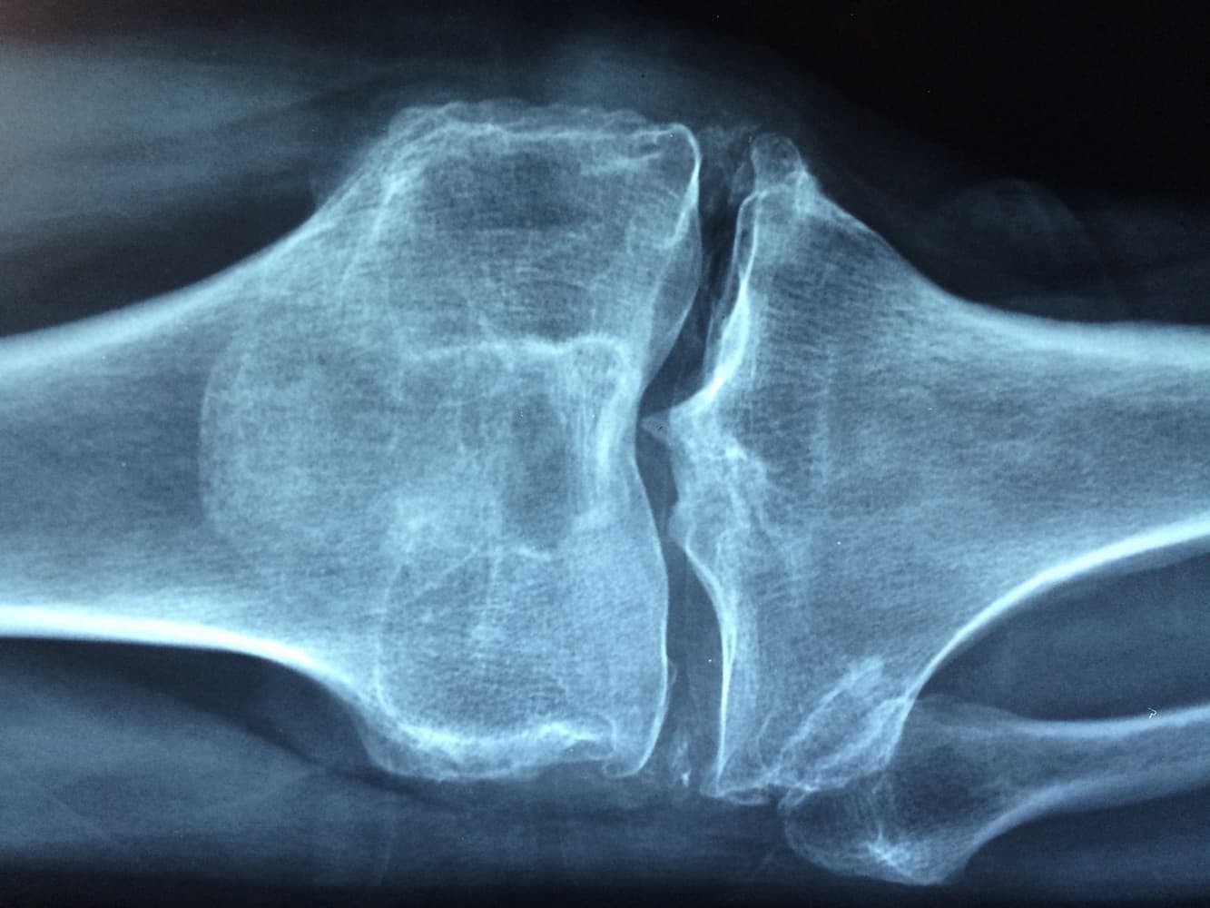 All You Need to Know About Osteoarthritis