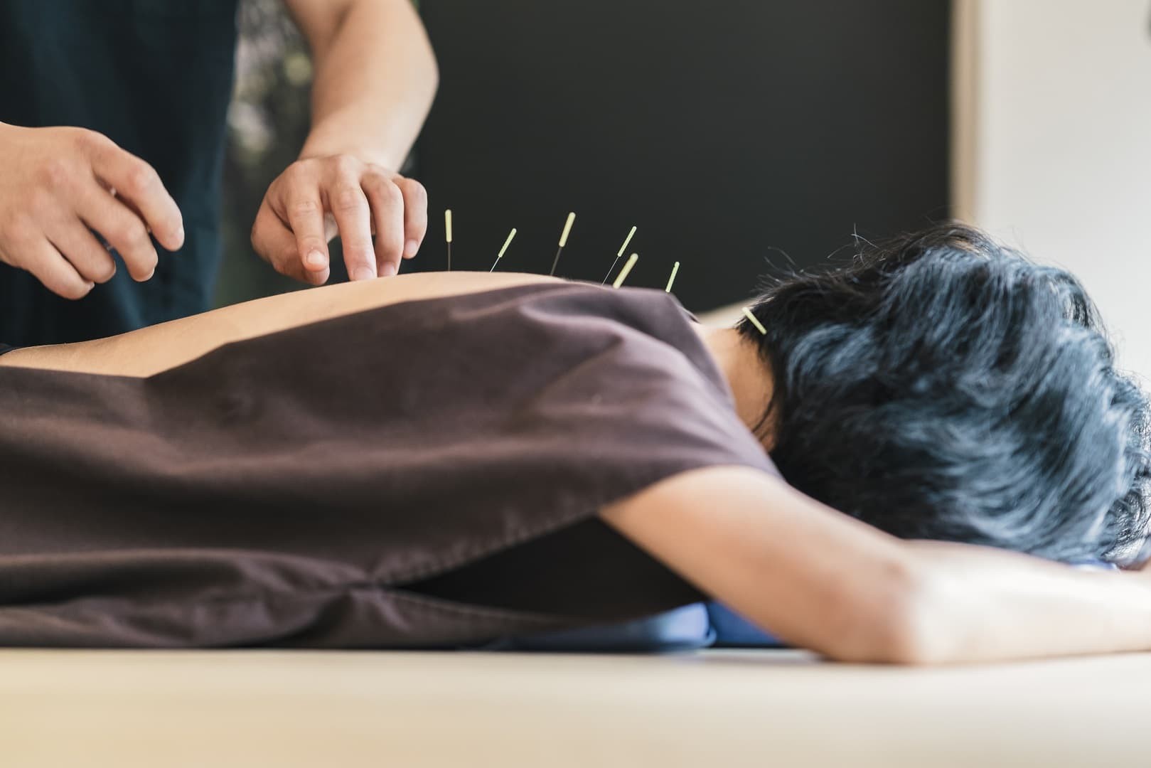 Acupuncture May Help Stress, Anxiety and Insomnia Well