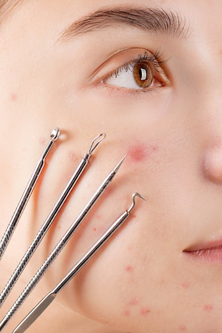 Everything You Need to Know About Acne