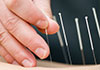 New Farm Acupuncture and Natural Therapies therapist on Natural Therapy Pages