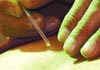 Acupuncture & Sports Injury therapist on Natural Therapy Pages