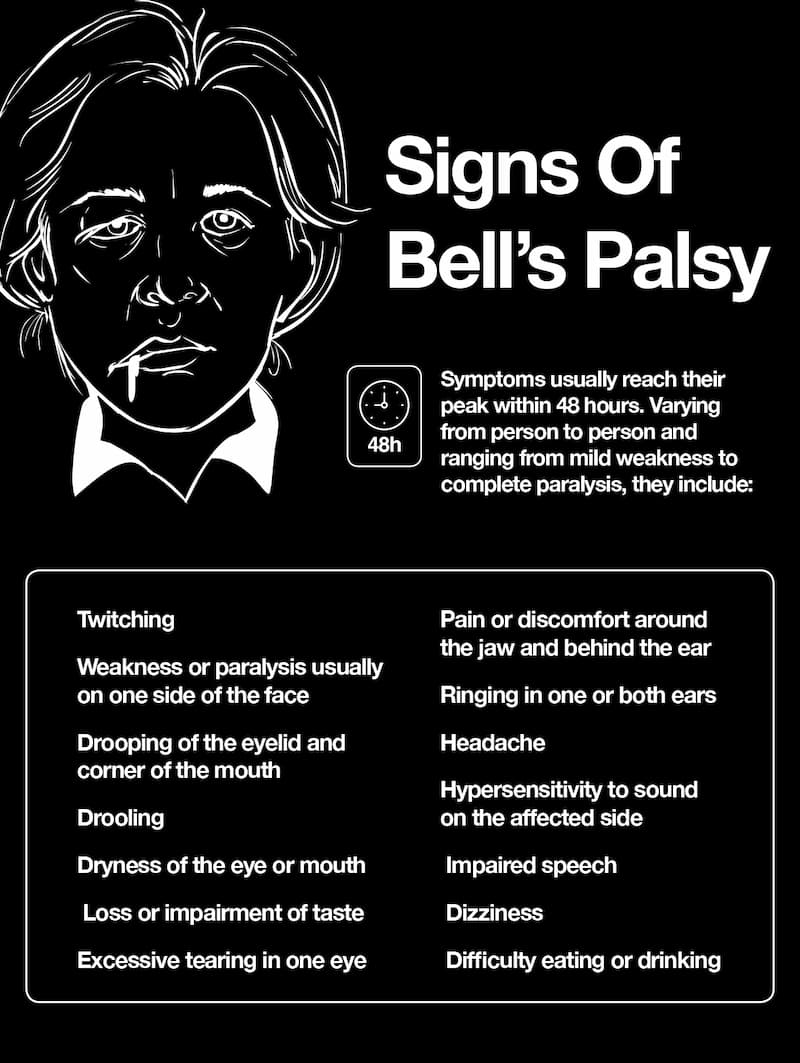 What are the symptoms of Bell's palsy?