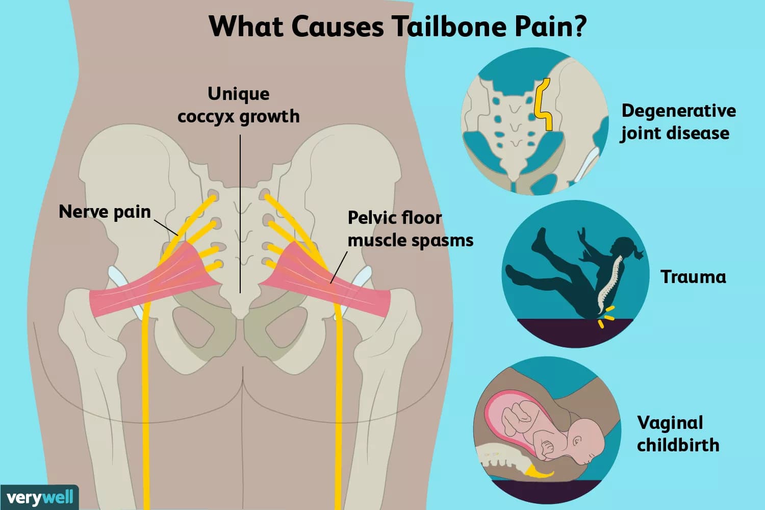 What causes tailbone pain?