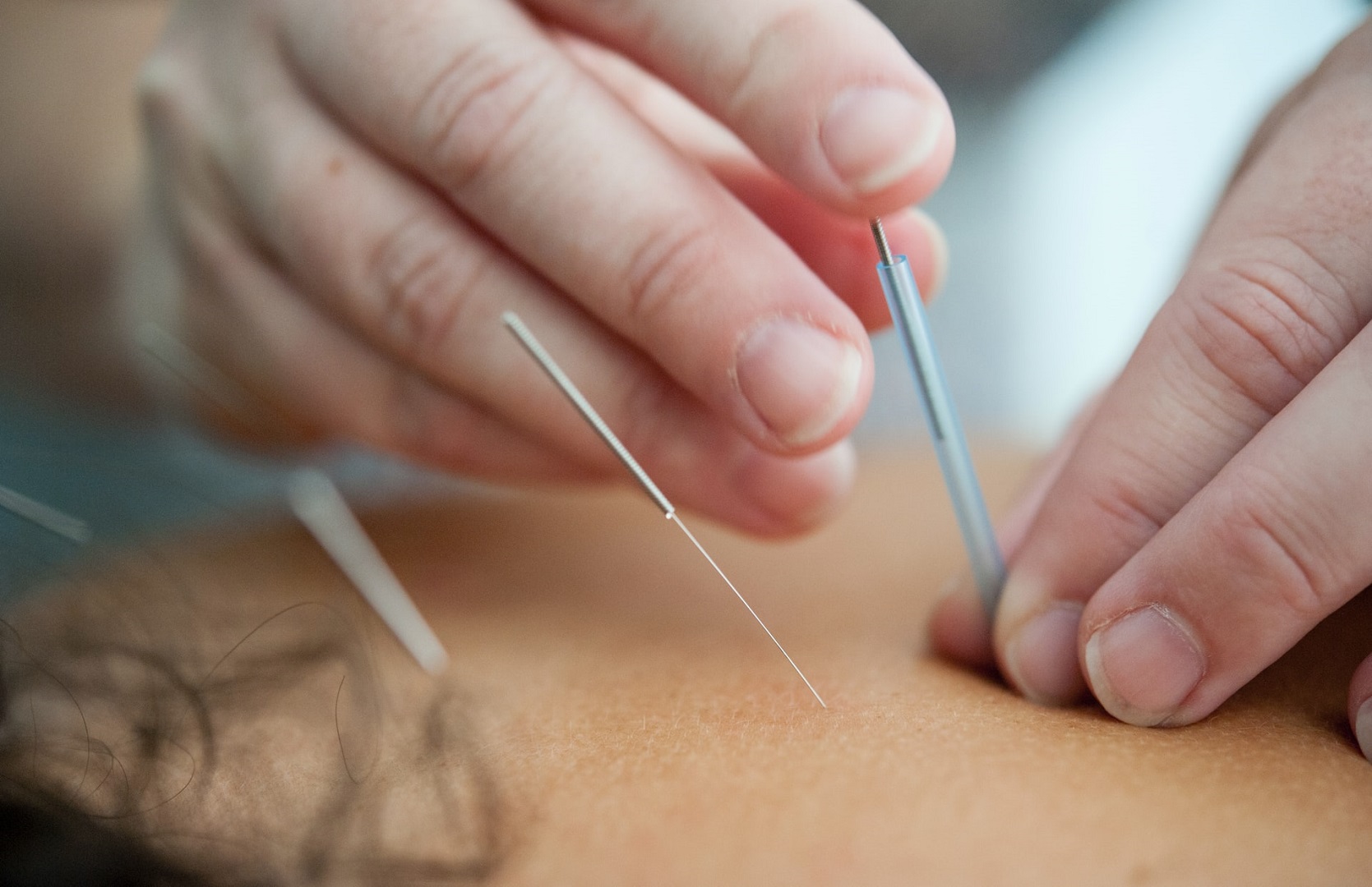 Acupuncture for IBS