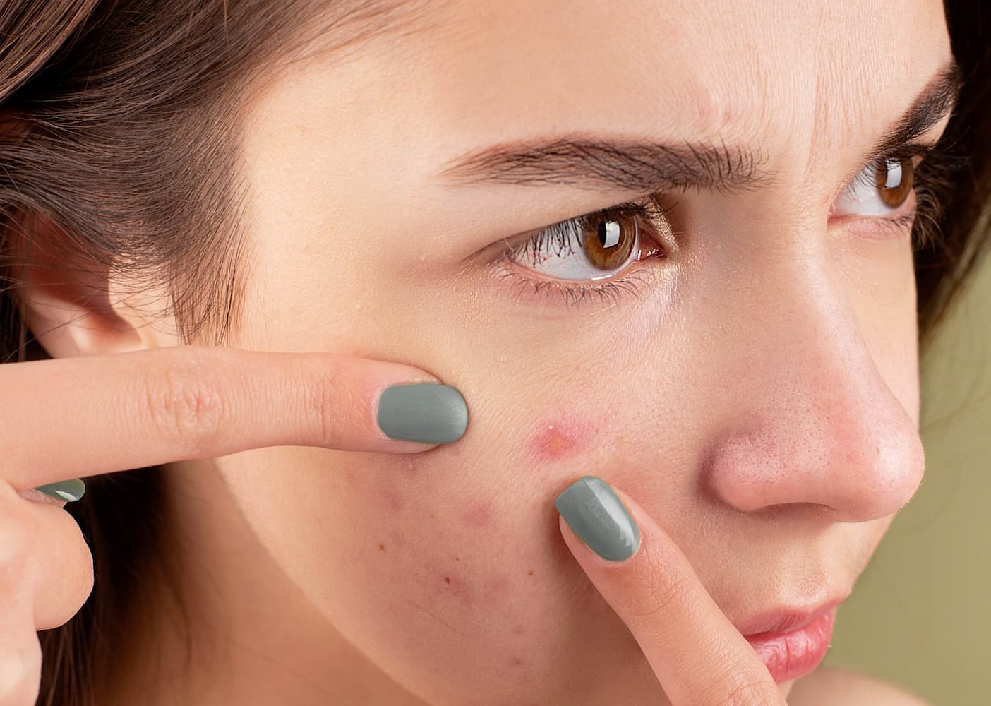 Acne, common skin conditions
