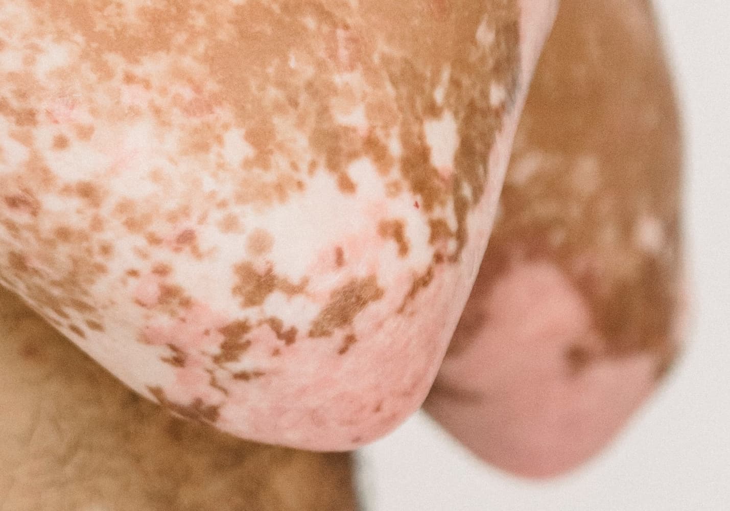 Psoriasis, common skin condition