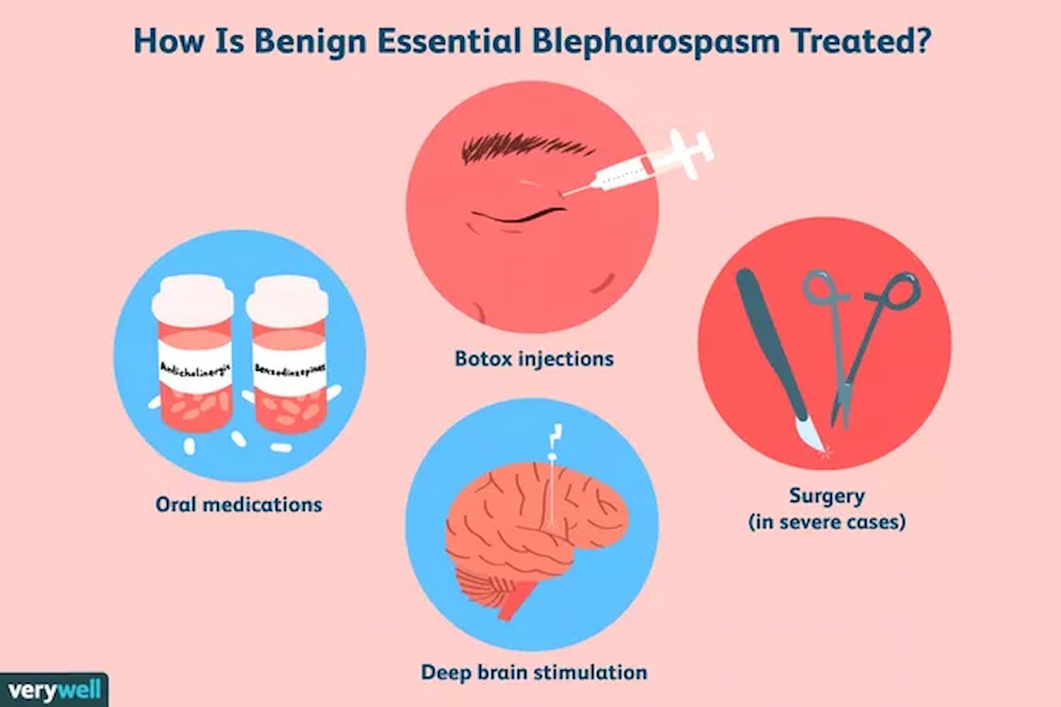 What are the treatment options for blepharospasm?