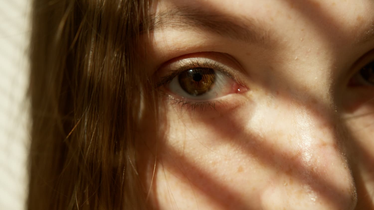 Eye Health Basics: What is Blepharospasm?