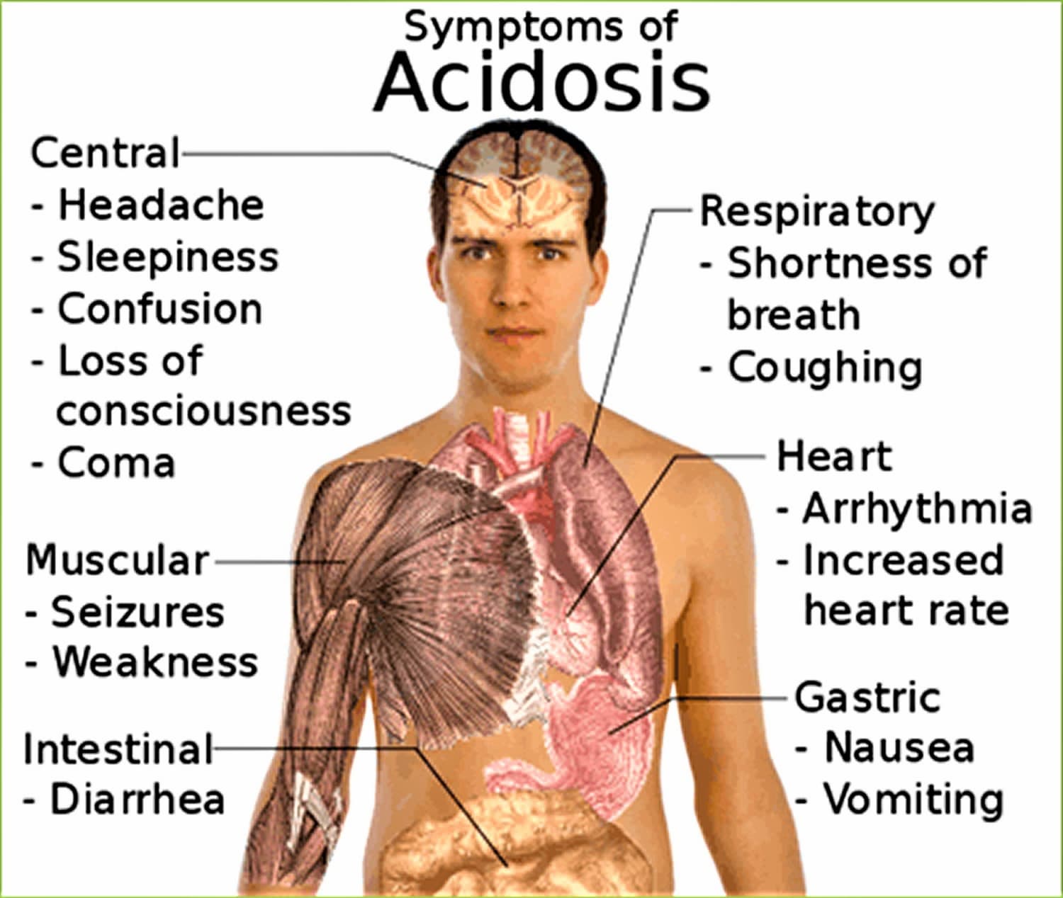 Everything You Need To Know About Acidosis What Is Acidosis Au 