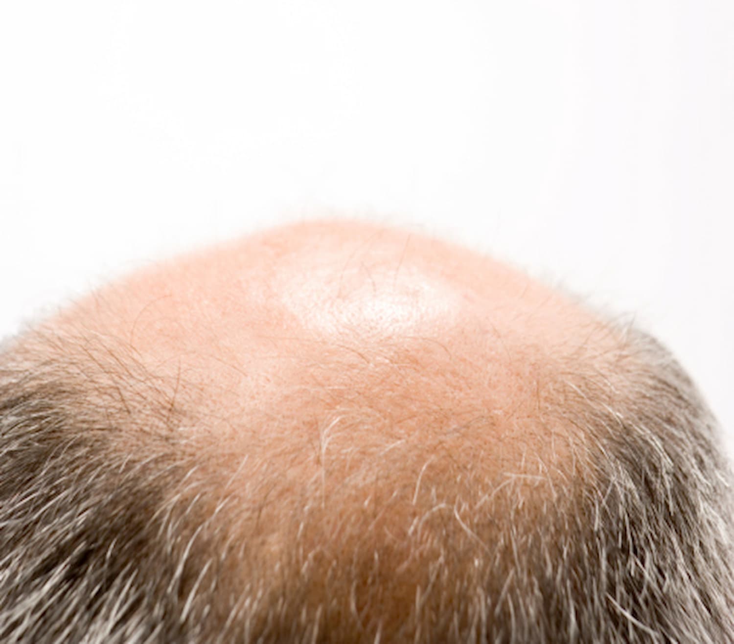 The Truth Behind Male Pattern Baldness