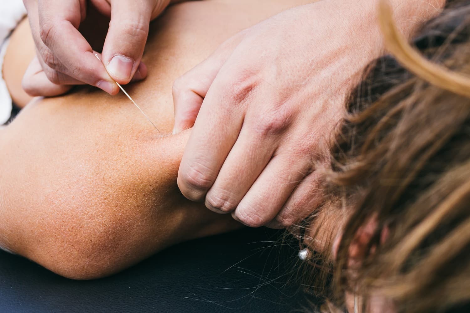 What is dry needling?
